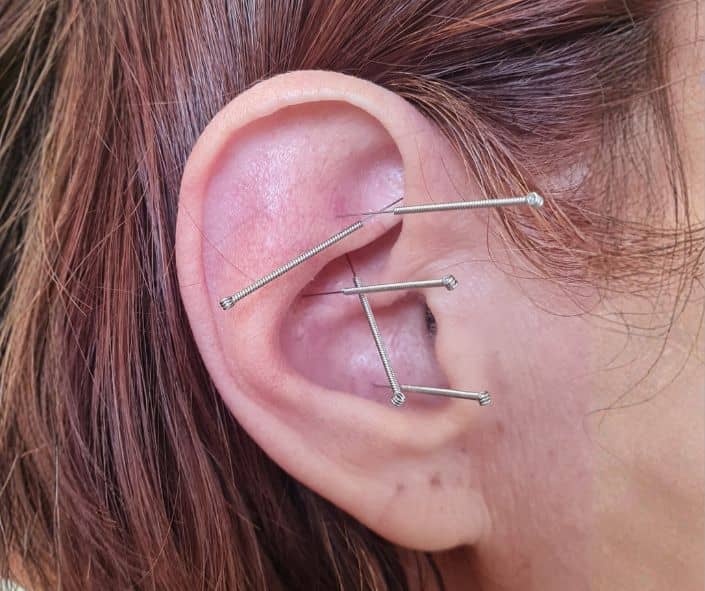 Pécelmed Ajszika Természetgyógyászat akupunktúra